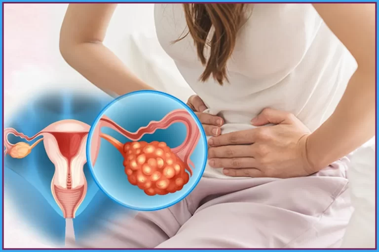 PCOD Explained Symptoms, Causes, Diagnosis & Treatment Options Blog Feature Image